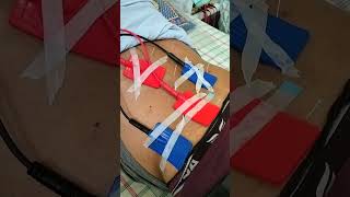 Lower back acupuncture treatment [upl. by Suzann413]