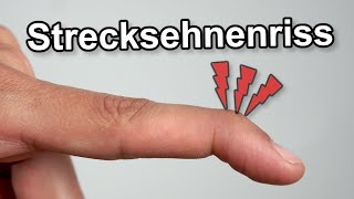 Was tun bei MalletFinger bzw Hammerfinger [upl. by Noicnecsa841]