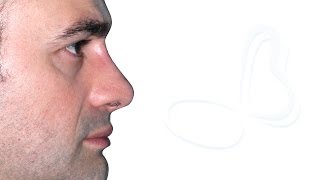 REVISION RHINOPLASTY RESULT YOUnique Rhinoplasty by Pietro Palma [upl. by Adnalohs]