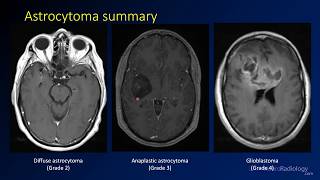 Imaging brain tumors  2  Astrocytomas [upl. by Ayin]