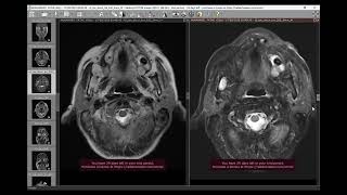 Gorlin syndrome [upl. by Gibson]