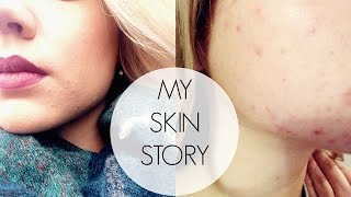 SKIN STORY  How I got rid of my acne  Products I use [upl. by Bettina]