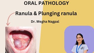 Ranula  Oral Pathology  Understand in 5 Mins [upl. by Naziaf332]