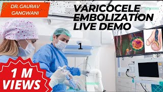 Live Varicocele Embolization Case 1 Nonsurgical treatment of Varicocele  Dr Gaurav Gangwani [upl. by Ykceb]