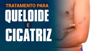 Tratamento para queloides e cicatrizes [upl. by Goldner]