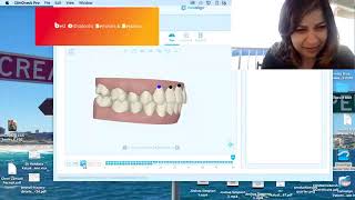 Invisalign Class II deep bite correction [upl. by Nilhsa306]