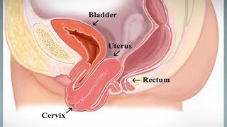 ¿Qué es el prolapso uterino [upl. by Anerroc]