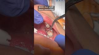 BAND amp LOOP Space maintainer oralhealth viral trending youtubeshorts kidsdentitryshorts brac [upl. by Arehahs651]