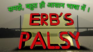 Erbs Palsy [upl. by Ibrab]