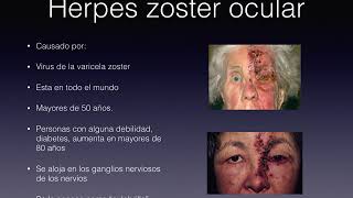 Herpes zoster ocular [upl. by Irmo549]