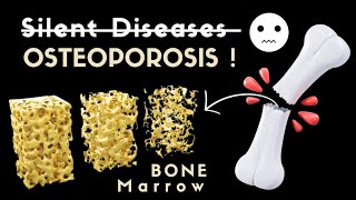 OSTEOPOROSIS  Silent Disease 😶  Bones weakness [upl. by Ttayw]