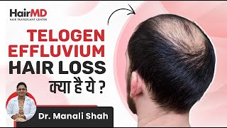 क्या है Telogen Effluvium Hair Loss  Reasons for Telogen Effluvium  HairMD Pune [upl. by Bilbe]