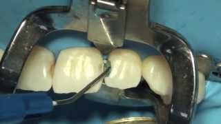 Tokuyama Dental Estelite Sigma Quick ile Restorasyon [upl. by Rubie228]