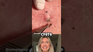 Tackling a TON of Blackheads 😳🖤 BlackheadRemoval [upl. by Kostman69]