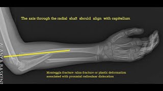 Monteggia Fracture and Equivalents [upl. by Rikki]