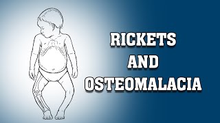 RICKETS AND OSTEOMALACIA [upl. by Mildred]