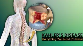 Kahlers Disease Causes Signs and Symptoms Diagnosis and Treatment [upl. by Wooldridge538]