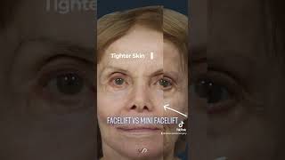 Facelift vs Mini Facelift Understanding the Difference  Dr David Stoker [upl. by Hemphill]