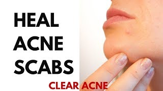 HOW TO HEAL ACNE SCABS [upl. by Finer]