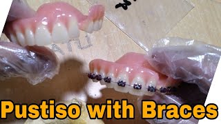 Pustiso with Braces and Acrylic Dentures [upl. by Kean]