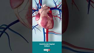 Ventricular Septal Defect Surgery ↪ 3D Medical Animation Shorts VSD VentricularSeptalDefect [upl. by Eiznyl]