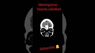 Meningioma heavily calcified shorts trending education [upl. by Eirehs]