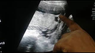 Placenta Previa  Major Posterior Placenta Previa [upl. by Gridley]