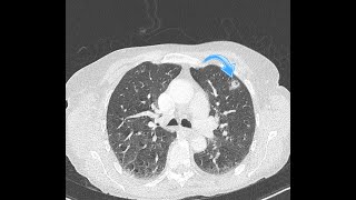 Chest Diseases illustrated by clinical cases  N ° 2 [upl. by Aneekal417]