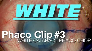 Phaco Clip 3  White Cataract Phaco Chop [upl. by Clymer367]