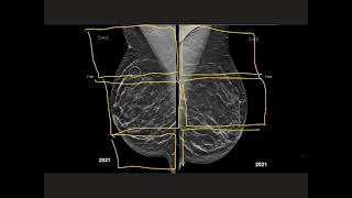 How to read a screening mammogram [upl. by Nosak]