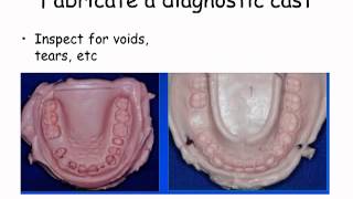 Diagnostic impressions and cast [upl. by Madson750]