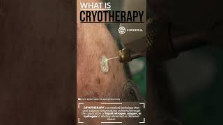 What is Cryotherapy Cryoablation or Cryosurgery medical mole skintreatment skin cryo [upl. by Bob687]