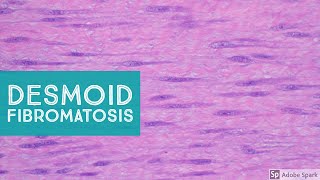 Desmoid Fibromatosis Desmoid Tumor  Explained by a Soft Tissue Pathologist [upl. by Aynatahs]