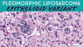 Pleomorphic Liposarcoma Epithelioid Variant [upl. by Pelligrini]