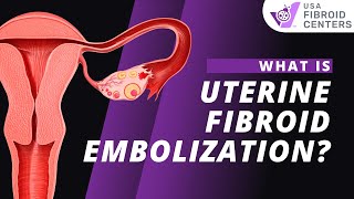 Watch How UFE Uterine Fibroid Embolization Works [upl. by Dodson]