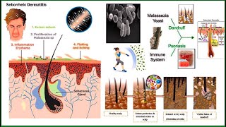 Seborrheic Dermatitis and Its Approach explained by Dr Makkar from Homeopathic website Askdrmakkar [upl. by Nillad]