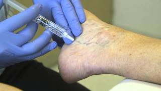 This simple procedure makes varicose veins disappear [upl. by Fabri]