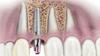 Duelen los Implantes Dentales [upl. by Cyrus]