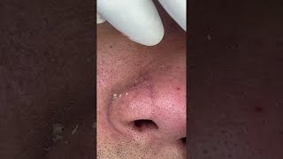 Big Cystic Acne Blackheads Extraction Blackheads amp Milia Whiteheads Removal Pimple Popping shorts [upl. by Inan]