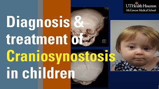 Diagnosis and Treatment of Craniosynostosis in Children [upl. by Ettolrahs]