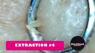 Whitehead and BlackHead RemovalExtraction 4 Reedit [upl. by Killen]