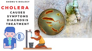 Vibrio cholera causes symptoms prevention and diagnosis [upl. by Calista662]