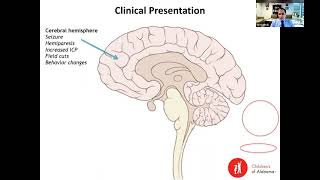 “Management of Infant Medulloblastoma–Historical Perspective and Treatment in the Molecular Era” [upl. by Adina]