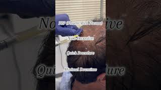 PRP Hair Restoration [upl. by Berey]