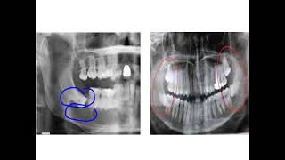 Dentigerous cyst [upl. by Aneeuqahs]