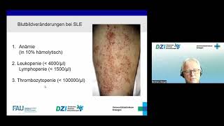 DZIWebinar „Kollagenosen – Autoimmunität im ganzen Körper Teil 2“ 22 06 2022 [upl. by Dian]