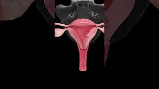 🎗️ Understanding Endometrial Cancer A Growing Concern for Women’s Health 🎗️ [upl. by Lozar]