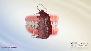 Hawley Retainer  Orthodontic Device [upl. by Marquita]