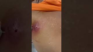 Left shoulder big cyst  but he refused for incision amp drainage [upl. by Avat]