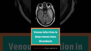 Venous infarction in deep venous sinus thrombosis  Radiology tutorials  video 56 [upl. by Llerral]